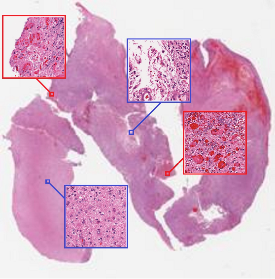 Whole Slide Tissue Image of a grade IV tumor.png
